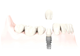 Implantes Nobel Biocare