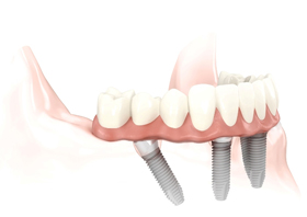 Implantes Nobel Biocare